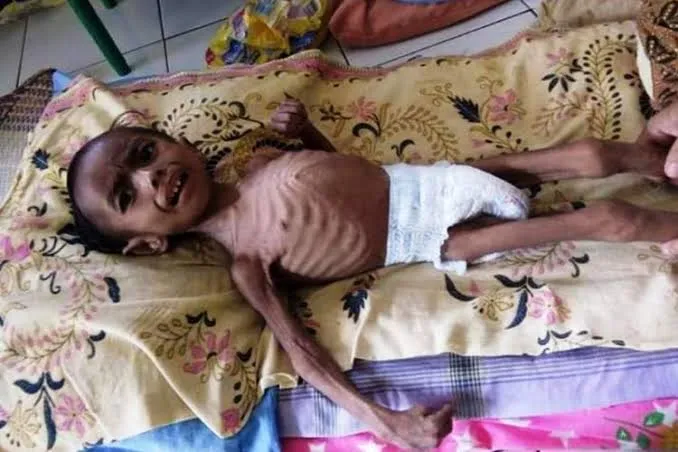 Kekurangan Gizi Mengancam Hampir Seribu Balita di Aceh Utara