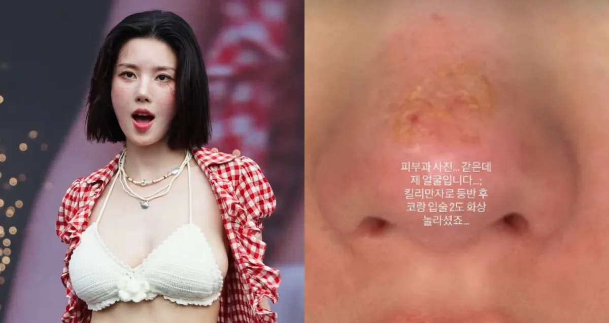 Kwon Eun Bi Alami Luka Bakar Parah Setelah Pendakian Kilimanjaro