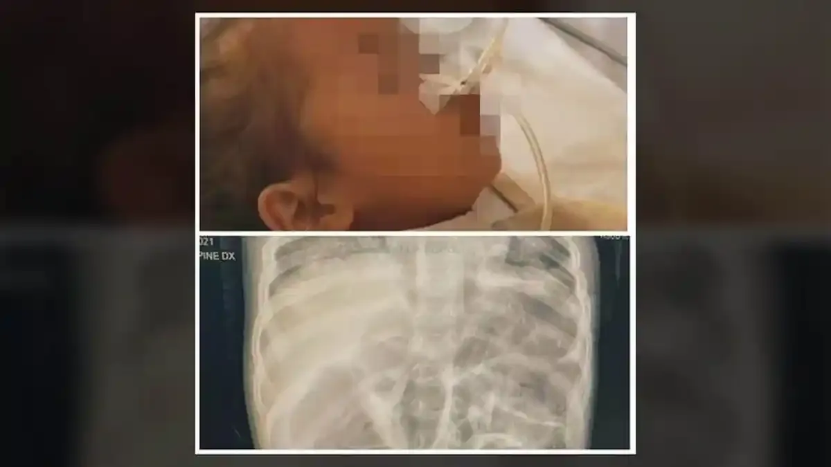 Kelemahan Deteksi Dini Terungkap dalam Kasus Meninggalnya Anak Akibat Cacingan di Sukabumi