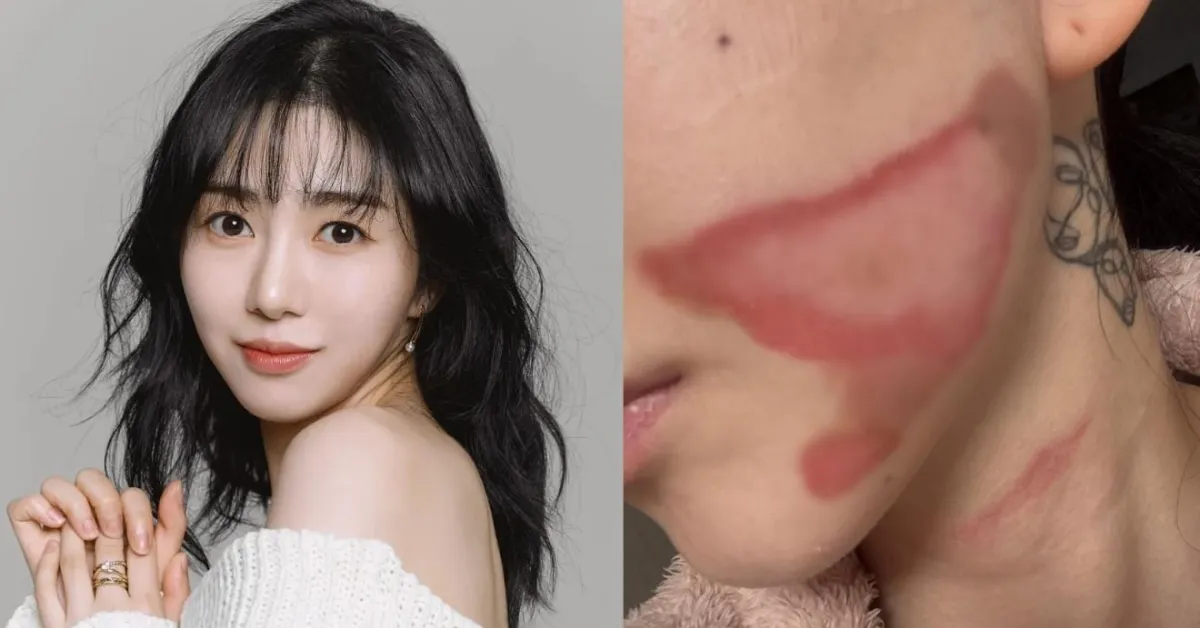 Kwon Mina Alami Luka Bakar Parah Usai Operasi Kosmetik