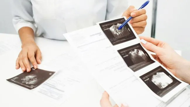 Deteksi Sindrom Down Selama Kehamilan: Penjelasan dari Dokter