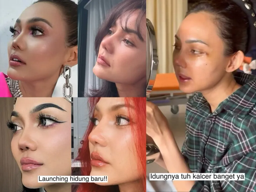 Rina Nose Jalani Operasi Plastik untuk Peremajaan Wajah