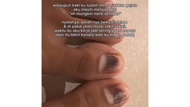 Kisah Tragis Perempuan Operasi Kuku Akibat Nail Art Pertama