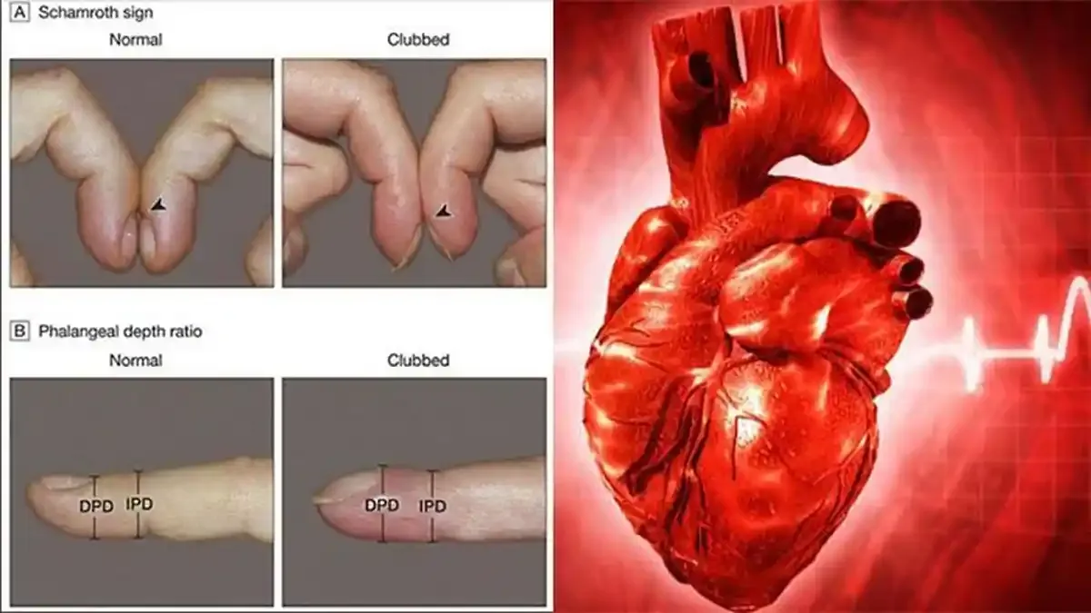 Deteksi Penyakit Jantung Melalui Posisi Jari Tangan