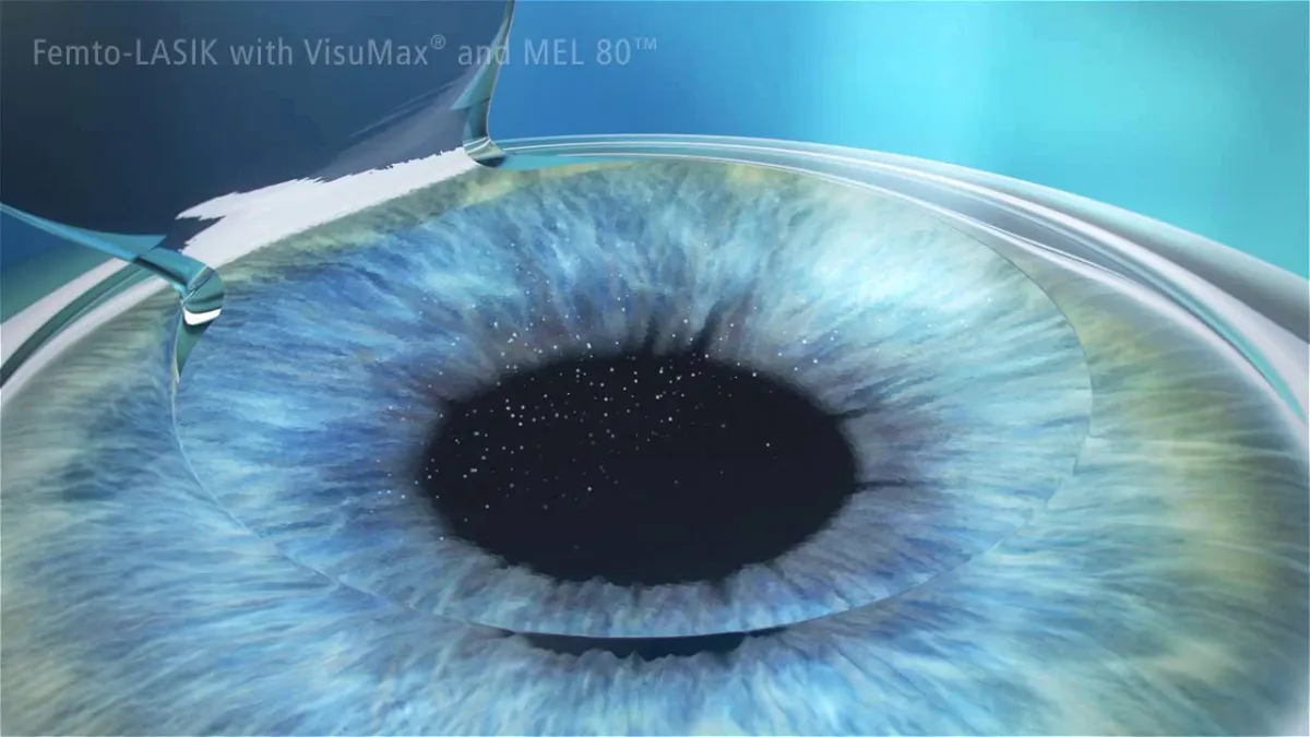 KMN EyeCare Luncurkan Teknologi SiLK: LASIK Non-Flap untuk Pengobatan Mata yang Lebih Nyaman