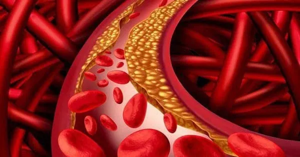 Diet Sehat sebagai Kunci Menurunkan Kolesterol dan Melindungi Kesehatan Jantung