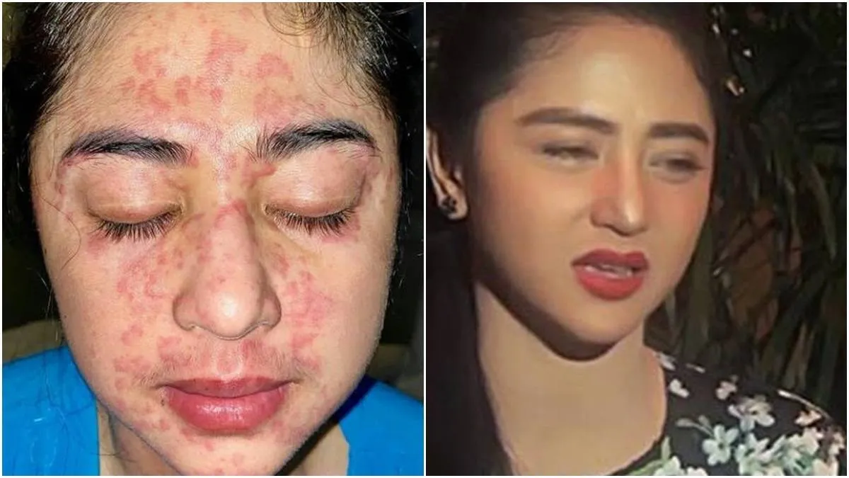 Dewi Perssik Sembuh dari Covid-19 Setelah Alami Gejala Langka