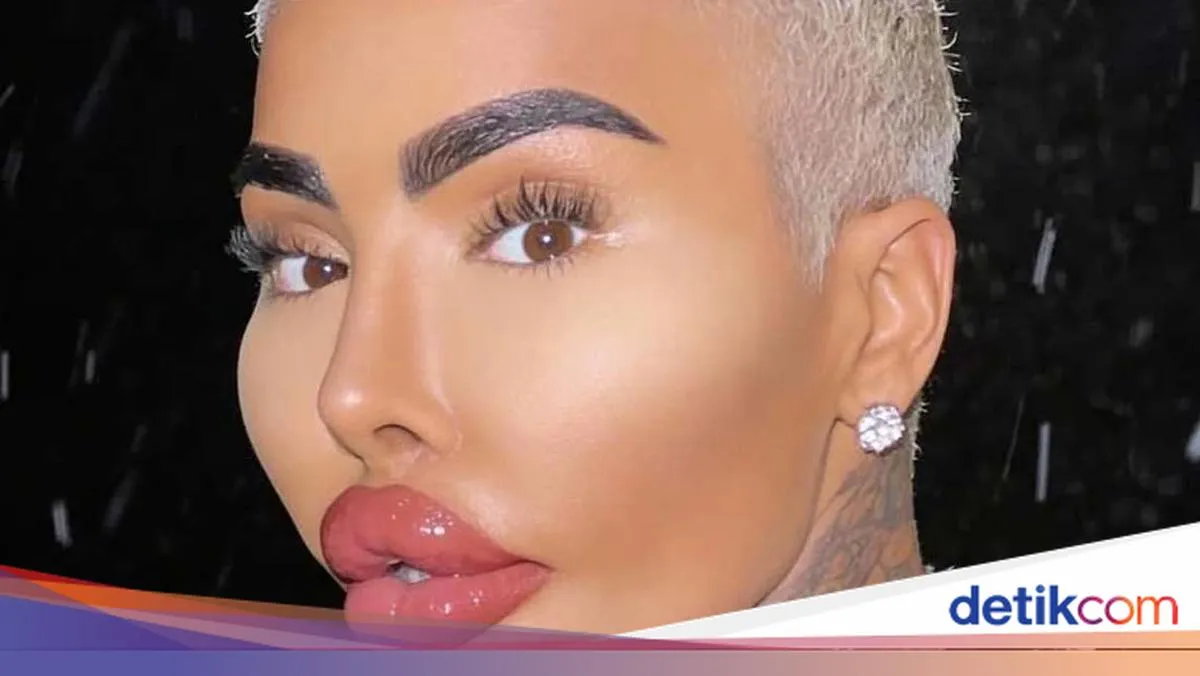 Influencer 'Lip King' Jordan James Parke Meninggal Usai Operasi Plastik