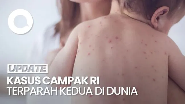 Kasus Campak di Indonesia Menjadi Kedua Terbanyak di Dunia