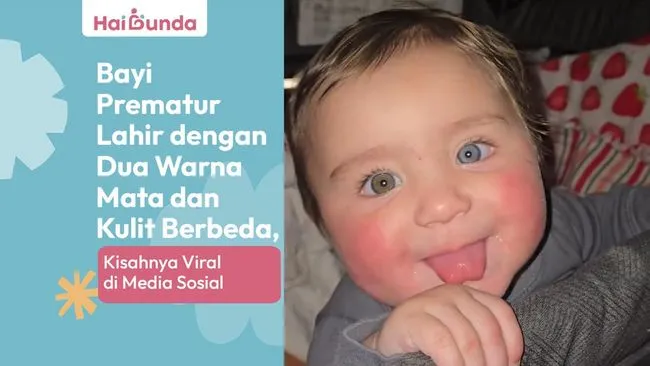 Bayi Prematur Unik dengan Dua Warna Mata dan Kulit Berbeda Viral di Sosial Media