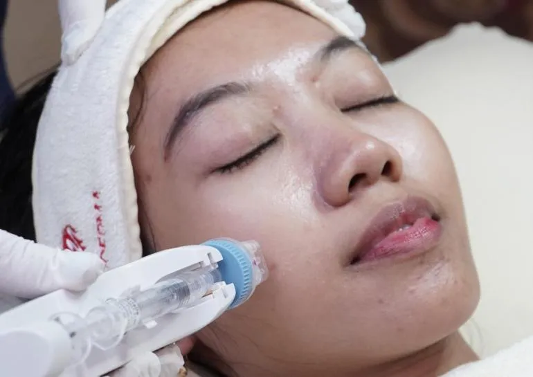Immoderma Clinic Perkenalkan Remee Pro: Teknologi Skinbooster Terkini dengan Diskon Spesial