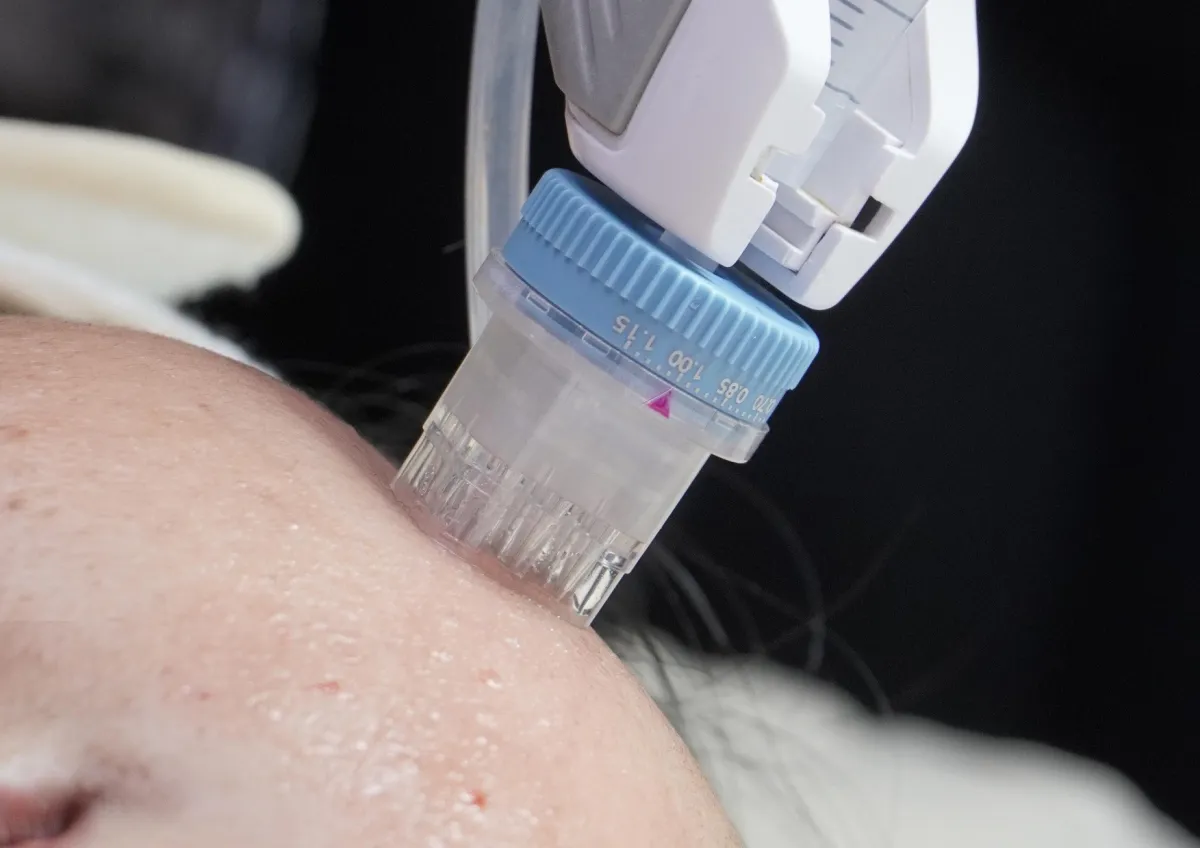 Immoderma Clinic Luncurkan Remee Pro untuk Skinbooster Optimal