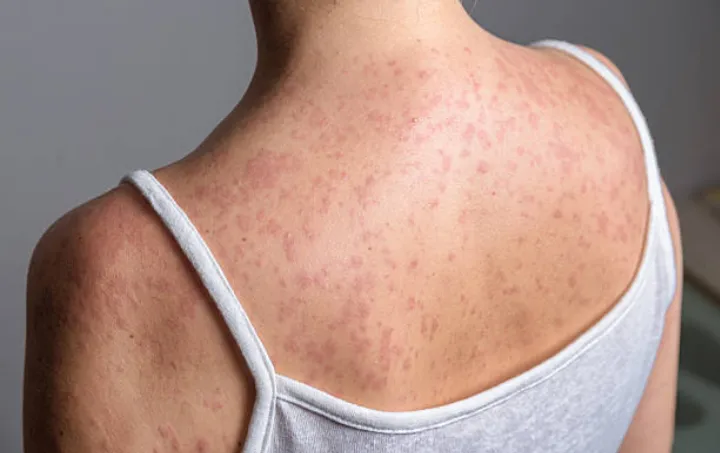 Dugaan Infeksi Campak Influencer Soroti Pentingnya Isolasi Diri