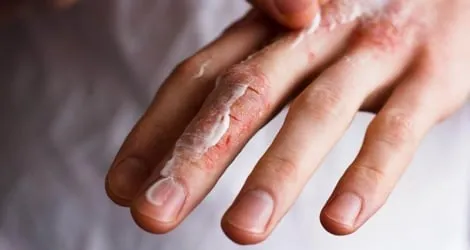 Peningkatan Kasus Iktiosis Kongenital di Kalangan Anak-anak